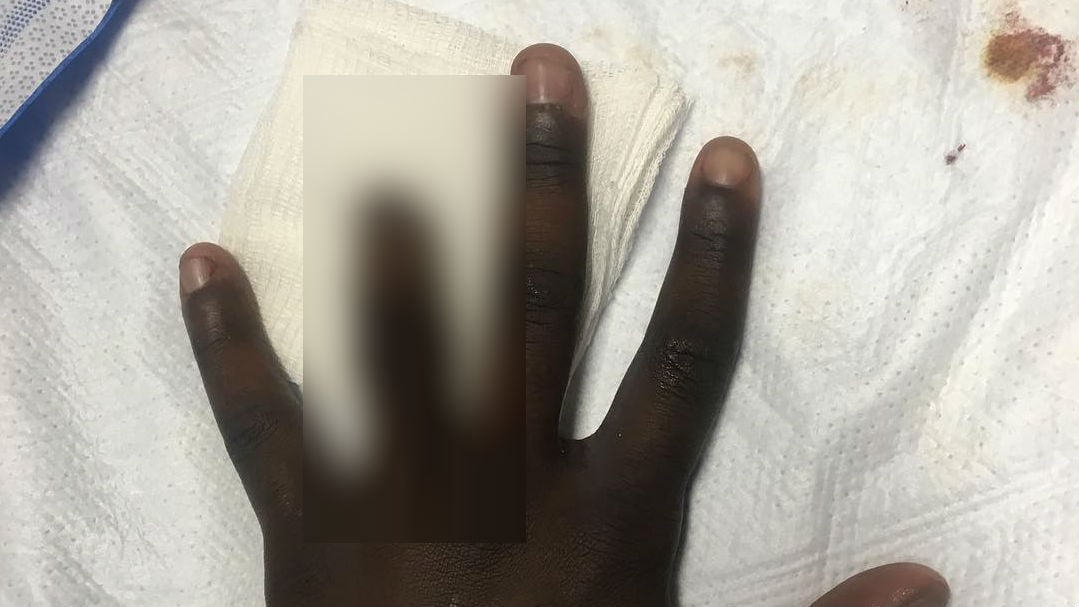 Chandler Smith loses tip of ring finger (via Instagram)